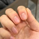 우태하한승경피부과의원 | 강남역 손가락 사마귀 냉동치료 피부과 전문의 있는 곳 우태하피부과의원 내돈내산