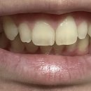 4513 | 퍼플E 미백치약 [퍼플이 치아 코렉트] 꾸준히 사용해본 후기