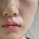 석전동300 | 진주근교 창원피부과 슈링크 300샷 후기