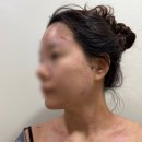대림세탁소 | 편평사마귀 내돈내산 제거 후기 (5년 간 3회 시술)