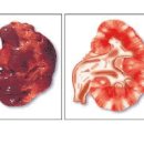 급성 신우신염 및 정보 원인 이미지