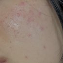 (주)허브메디헬스케어 | 디페린겔 사용법 부작용 각질 줄이는 법 2주차 후기와 같이 써본 피부장벽크림 추천