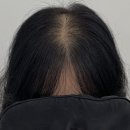 림스칼프