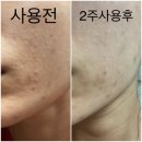 더마리본세트 2주후기 :좁쌀피부,접촉성피부염,지루성피부염 개선