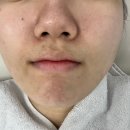 쌍문 피부관리 리애나뷰티 수유쌍문점 여드름케어 후기