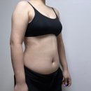 코오롱글로벌(주) 교대센터 | 복부 무한람스 후기 3주차 효과와 멍붓기 그리고 후관리 중저주파 레이저