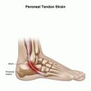 Peroneal Tendon Strain and Tendonitis 이미지