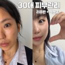 봄치과기공소 | 스킨부스터 리쥬란 엑소좀 창원구강악안면외과