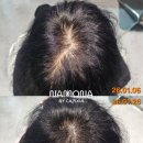 (주)제이솔루션 | 순천 정수리탈모 전문 | 부작용 걱정 없는 제이플라랩 비포&amp;애프터 공개