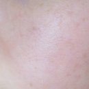 부암동리젠트힐 | 트로이필 피부재생술 이브뷰티센터 시술 후기