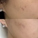 우림한의원 | 강남 여드름 한의원 새살침 여드름흉터색소침착 2회차 후기