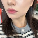 운천 | 광주 운천 피부과 콜라겐을 직접 주입하는 셀르디엠 후기 스킨부스터 + 비포에프터