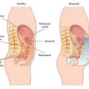 복막암 원인 복수 말기 4기 생존율 투석 검사방법 이미지