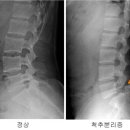 척추 분리증의 증상, 자꾸 다리 저리고 당기면? 이미지