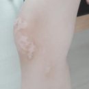 우태하한승경피부과 네이버블로그