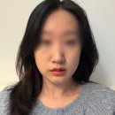 심피부과의원 | 역대급 만족스러운 세르프 300샷 3주 차 후기! 청담동 피부과 추천