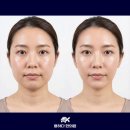 용하다한의원 | 한방스킨부스터 미주안(PN)약침