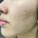 해피비비컴퍼니 | 솔에스떼에서 모공순삭 퀵트로이필 받고 왔당 + 관리 후 일주일 뒤에 쓰는 찐 후기