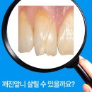 센텀치과기공소 | 도룡동치과/깨진 앞니 살릴 수 있을까요?