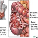 care plan : reagional enteritis (Crohn's disease) 이미지