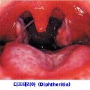 ﻿■ 구내염(Stomatitis), 다양한 원인과 치료 방법 이미지