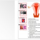 기능성 자궁출혈[dysfunctional uterine bleeding] 이미지