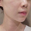 이수시원한의원 | 서울 이수역 피부과 티타늄 리프팅 후기: 티타늄 리프팅 가격, 주기, 효과, 통증, 부작용, 유지기간...