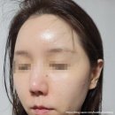 엑셀 | 잠실피부과 추천 여드름피부 코모공레이저 1회차후기 엑셀브이가격