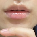 어린공주성형외과의원 | 입술필러 처음 맞아본 후기.. (통증/멍/부작용/붓기/밥/운동/화장)