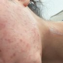 동작(2) | [서울/동작] 인더뷰티 여드름관리 내돈내산 2회차 후기