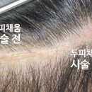 뇌출혈 수술후 생긴 흉터 두피커버 시술 후기 ;) 대전두피문신 도트바이림