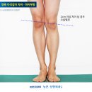 다리길이차이, 하지부동 키크는수술후기_ 17/02/11 뉴본정형외과 이미지