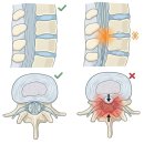 윈윈정형외과의원 | 오래 걷기 힘들다면 의심해야 할 척추관협착증 증상과 비수술 치료 :: 청주 윈윈 정형외과
