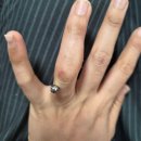 보나약국 | 손가락 내연골종 Enchondroma 천호역 정형외과 수술 후기 4편 pin 제거