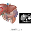 혈관종 증상 및 원인과 치료 방법 : 간 체리 신생아 이미지