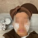 평안한의원 | 성남 분당 한의원 새살침 3회차 후기 여드름 파인 흉터 시술 후기 경과