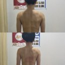 청주에스테틱 복대동 샤인스킨케어 뱀부테라피 예신관리 받고 온 후기