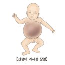 신생아 괴사성 장염(Necrotizing enterocolitis of fetus and newborn) 이미지