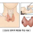 갑상선 경피적 에탄올 주입 시술 이미지