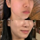 전주정형외과의원 | 전주 서신동 고주파리프팅 [필스토리의원] 써마지보다 좋은 쿨페이즈 600샷 후기