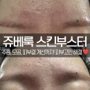 [03/20] 사진촬영 중급 과정(제품사진기법) | 인천 부평 피부과 쥬베룩 스킨부스터 4cc 얼굴 전체 효과와 리얼 후기(전후 비교 사진 있음)