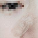해평의원 | [얼굴 봉합 후기] 응급실 방문 및 성형외과 얼굴봉합