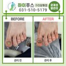 구리발각질 갈매동 문제성 발관리 '포쉬네일 하이푸스 구리갈매점'