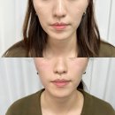 탑스뷰티 | 탑스뷰티 에스테인 아크네이징 후기, 청라 피부관리, 청라 에스테틱 추천