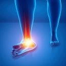 발목 삐끗 방치하면 발목 관절염 걸린다? 이미지