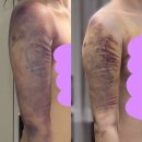 참평화약국 | [내돈내산 팔뚝 지방흡입 후기 : 5일차~7일차] 지방흡입 후 몸무게/체지방 변화, 항생제 부작용 대처...