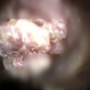 요도 | 요도 곤지름 초기 병원 치료 해도 후기 보면 재발 되고 힘든 이유!