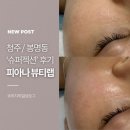 청주 피부관리 피아나뷰티랩 방문기, 슈퍼젝션 모공케어 후기