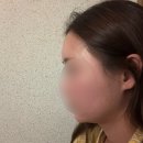 대구 반월당 이마필러, 턱필러 내돈내산 후기