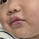 최영현장외과의원 | 부산 수의원 아기 봉합수술 후 울산 성형외과 제니스병원 흉터 재생주사